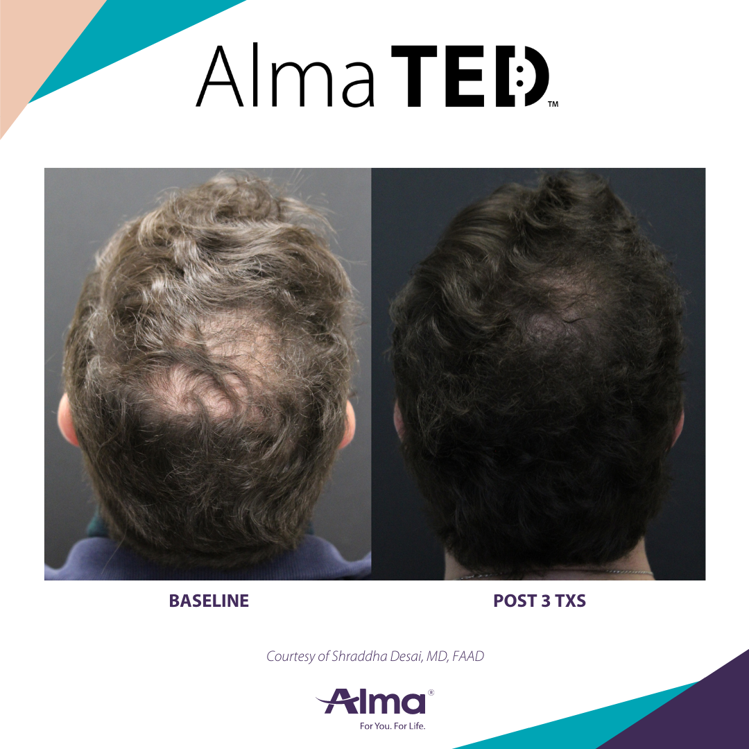 Alma TED hair loss treatment results for men.