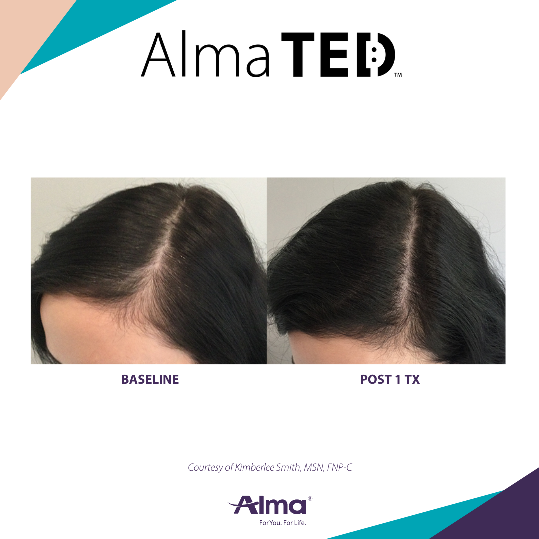 Alma TED hair loss treatment results for women.