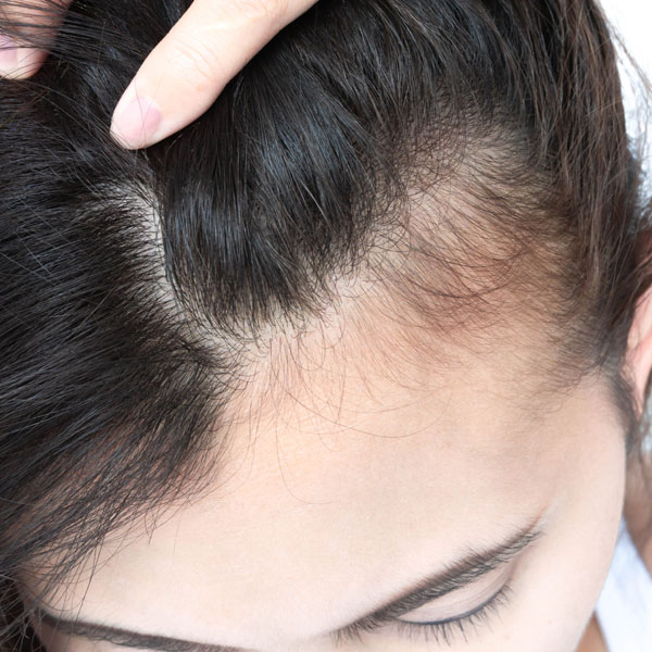 New Freedom Family Medicine is offering Alma TED hair loss treatment.